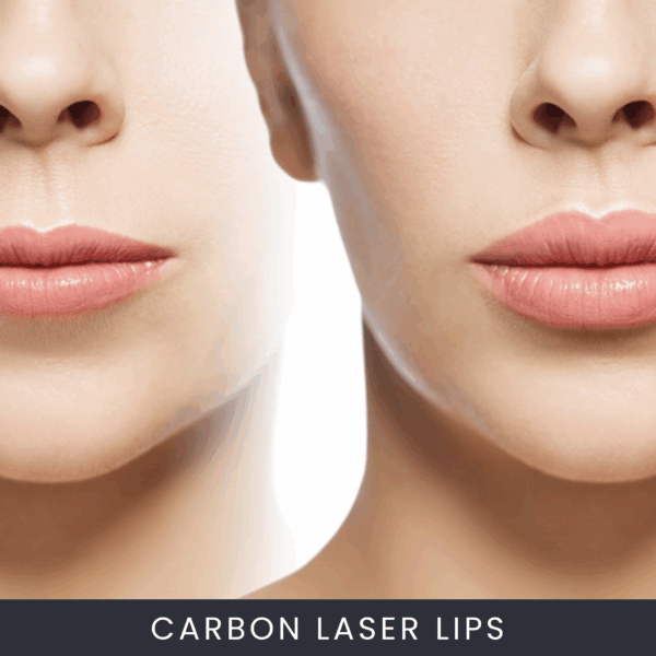 carbon-laser-lips Online Cursus Carbon Laser Lippen